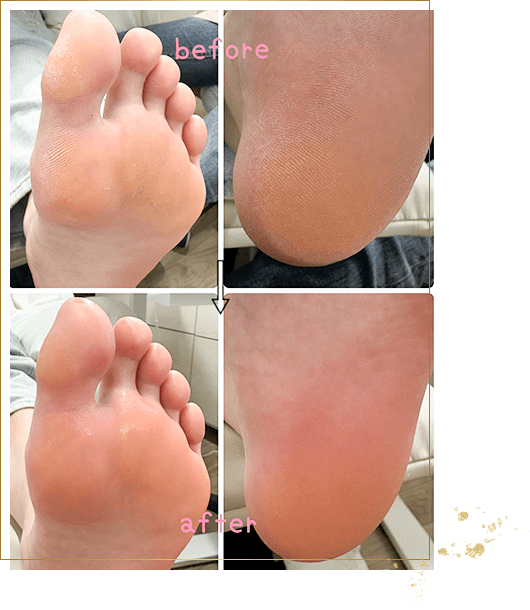 足裏角質の画像